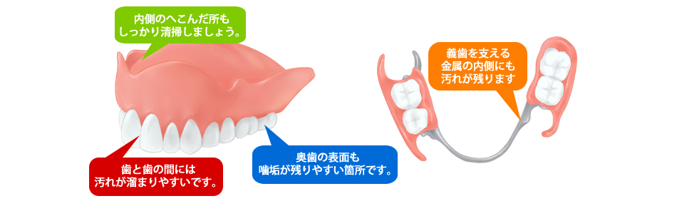 義歯（入れ歯）の清掃について