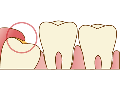 親知らずが少し出ている場合
