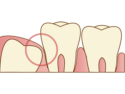 親知らずが歯茎の中に埋没している場合