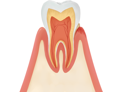 軽度の歯周病
