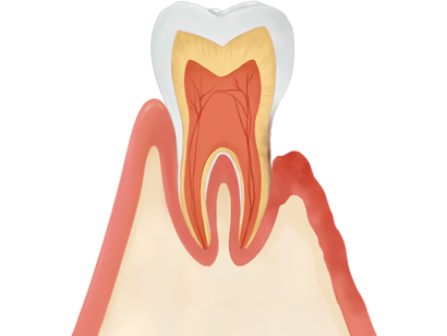 中度の歯周病