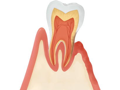 重度の歯周病